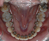 Orthodontie adulte Dentazur Cannes la Bocca (06150)  Centre Dentaire  Dentazur à Cannes la Bocca (06150)